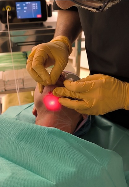 Endolift en el tratamiento de papada